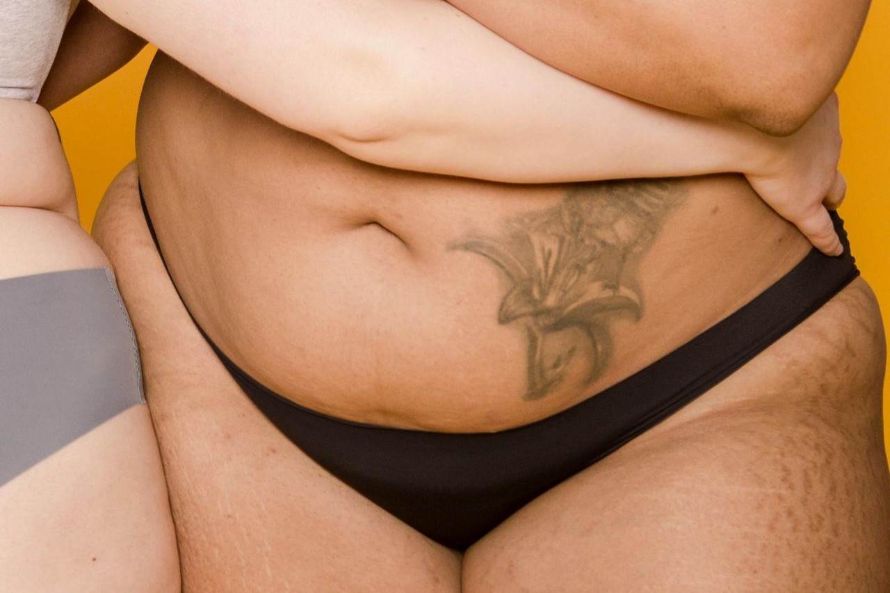 Postpartum abdominal skin with fine stretch marks visible in soft light